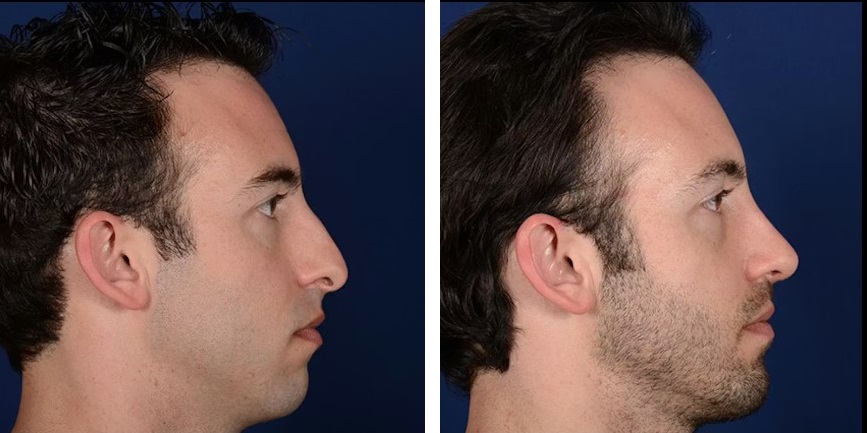 Mentoplastia caso 6 — antes y después